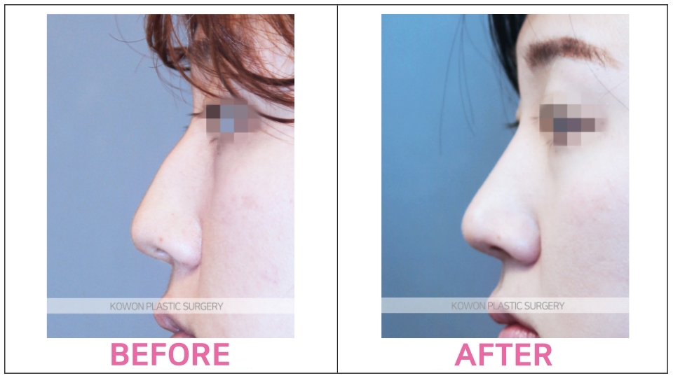 Rhinoplasty by type before and after