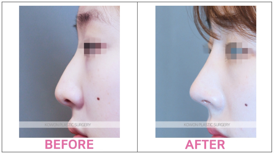 Rhinoplasty by type before and after