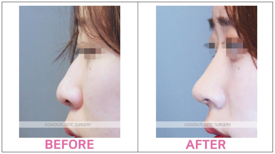 Rhinoplasty by type before and after