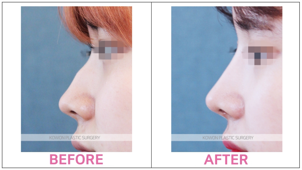 Rhinoplasty by type before and after