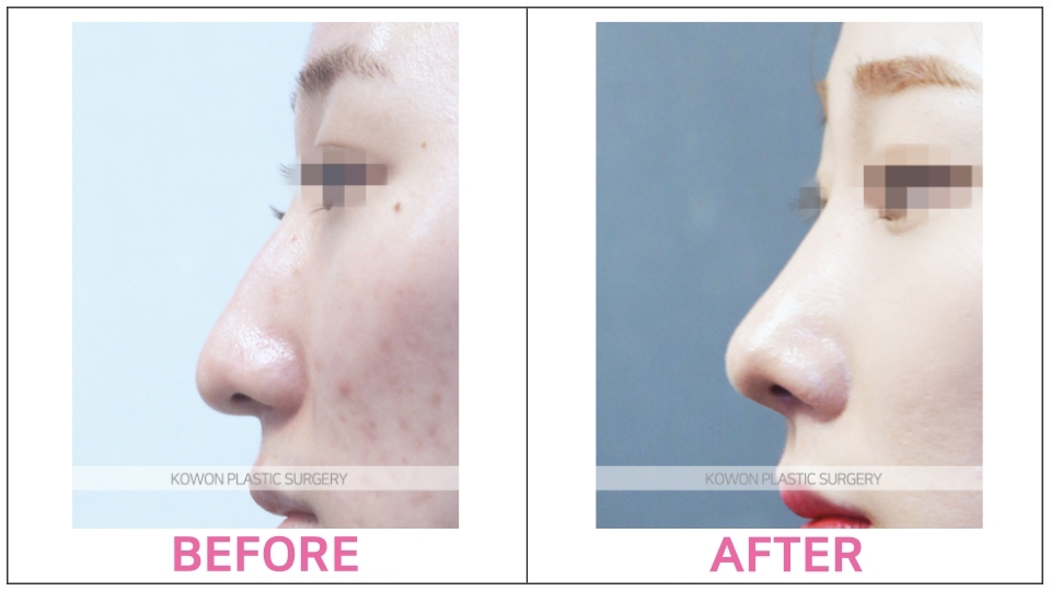 Rhinoplasty by type before and after