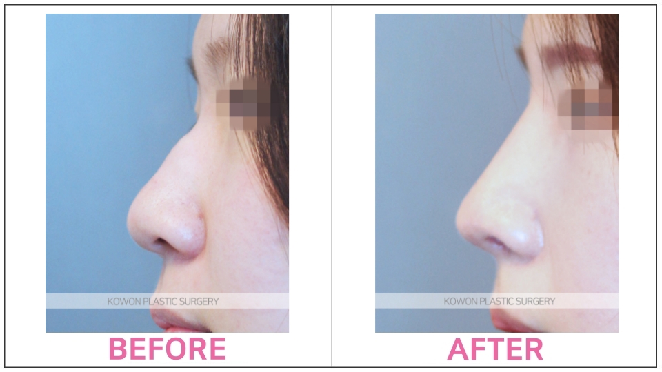 Rhinoplasty by type before and after