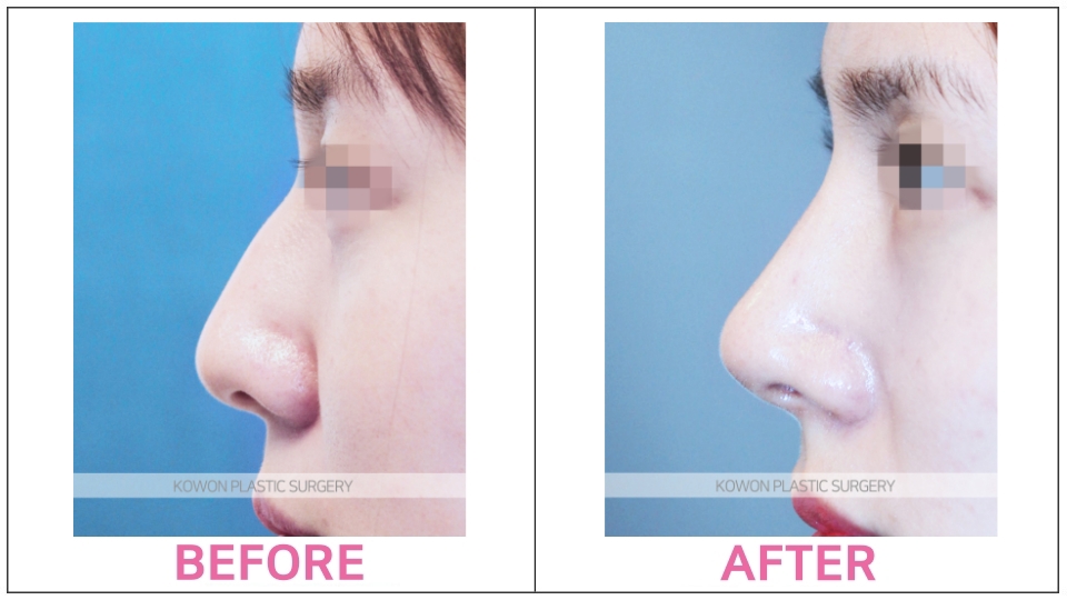 Rhinoplasty by type before and after