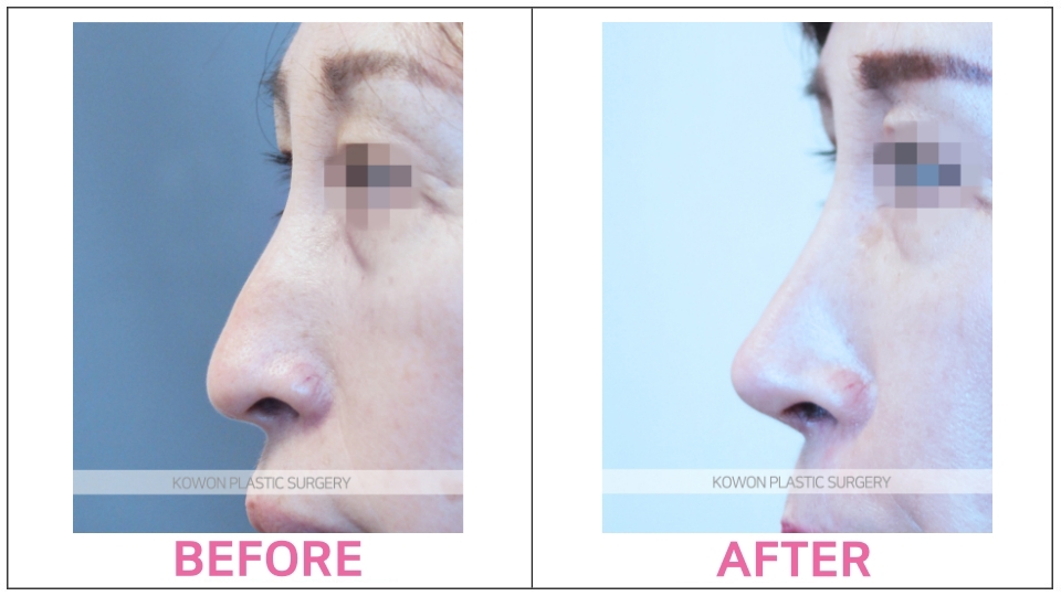 Rhinoplasty by type before and after