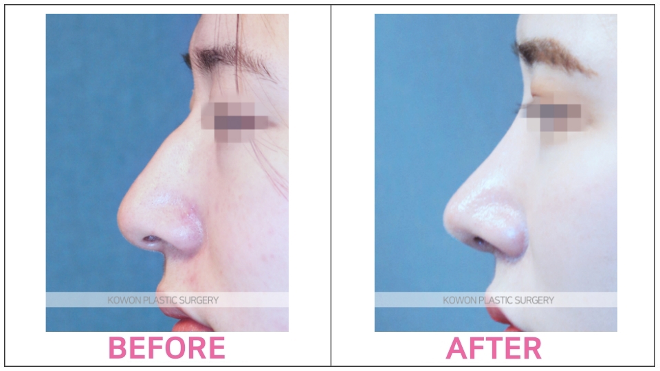 Rhinoplasty by type before and after