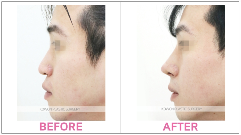 Rhinoplasty by type before and after