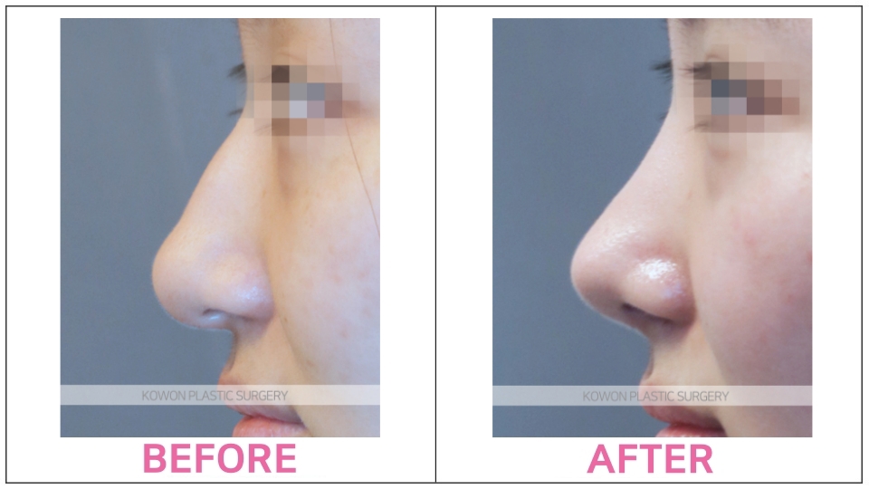 Rhinoplasty by type before and after