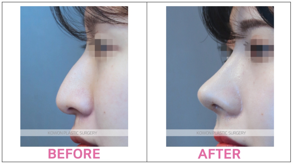 Rhinoplasty by type before and after
