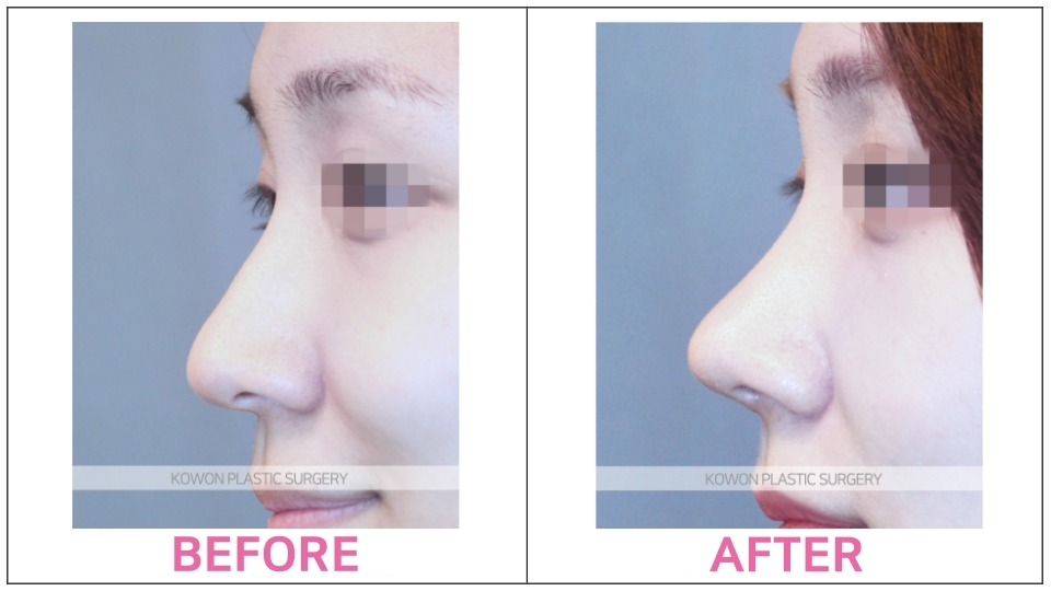 Rhinoplasty by type before and after