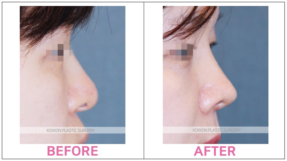 Rhinoplasty by type before and after