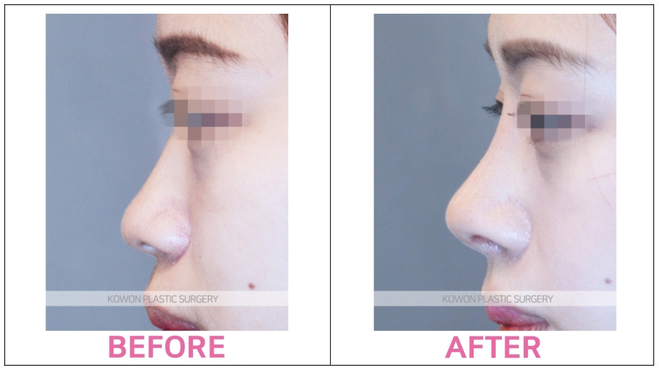 Rhinoplasty by type before and after
