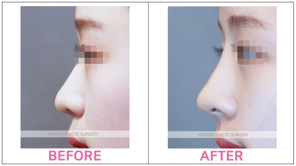 Rhinoplasty by type before and after