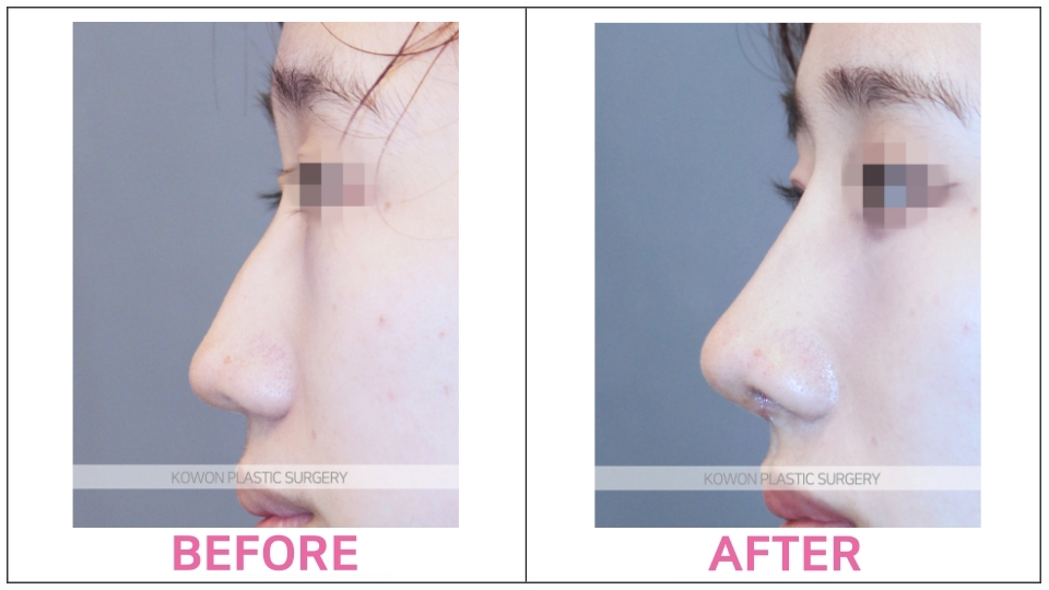 Rhinoplasty by type before and after