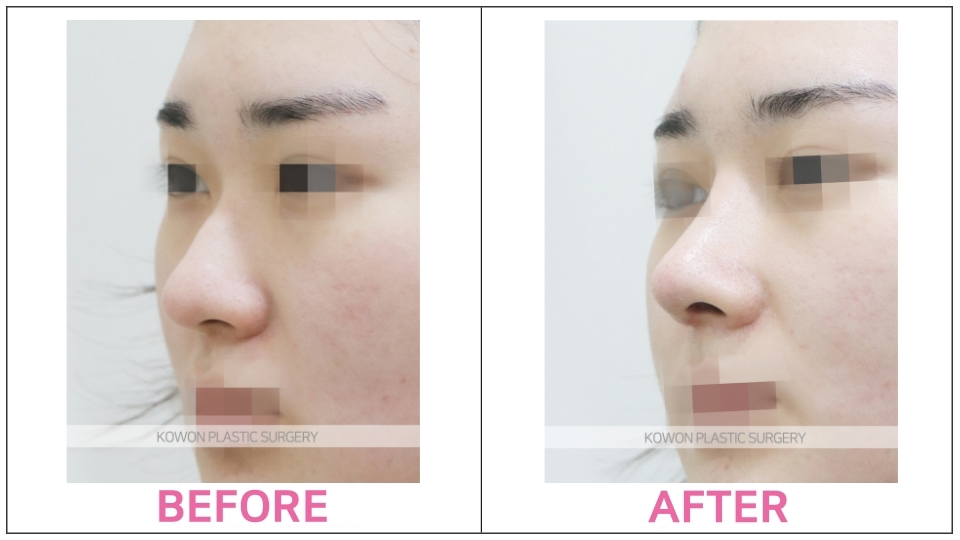 Rhinoplasty by type before and after