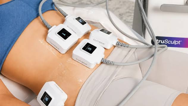 Handpiece truSculpt diletakkan pada abdomen pesakit untuk mengurangkan lemak.