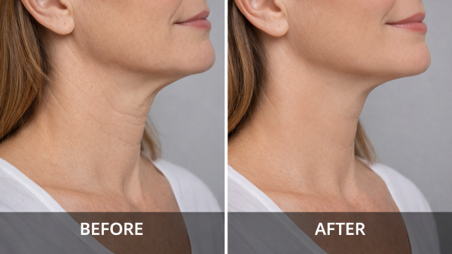 Neck Wrinkles & Skin Texture Changes before and after