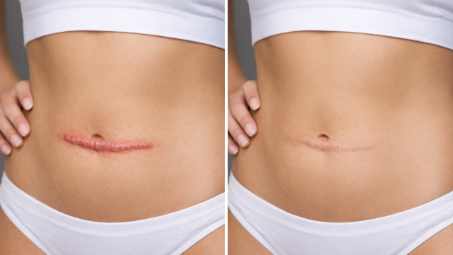 Before and After Image of surgical scar.