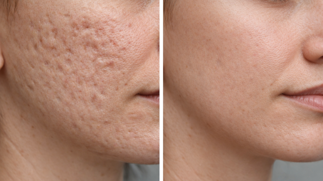 Before and After Image of acne scars.