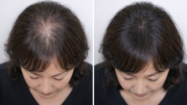 Before and After Image of  thinning hair and scalp concerns.