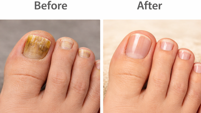 Before and After Image of  Fungal Nail Infection Treatment.