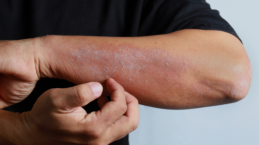 Atopic Dermatitis (Eczema) – MAST Test Available
