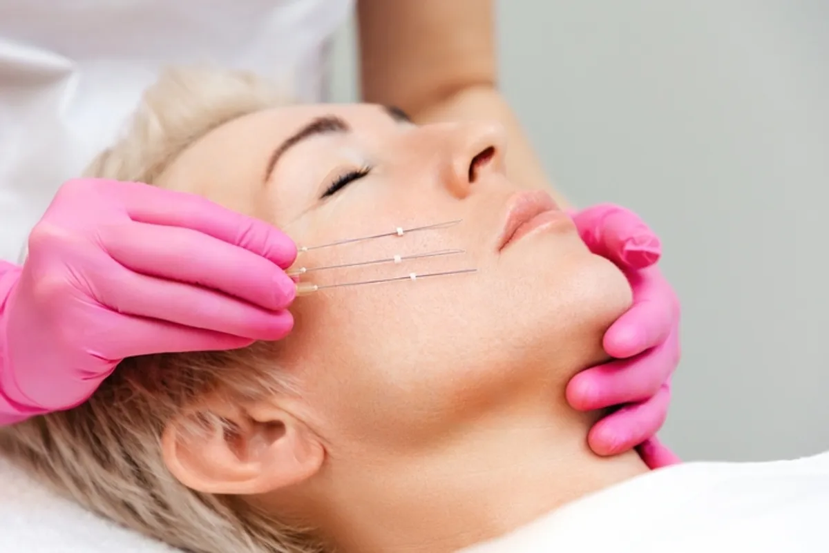 Thread Lift (Before You Turn 40)