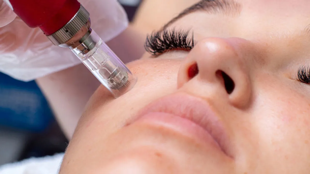 Microneedling