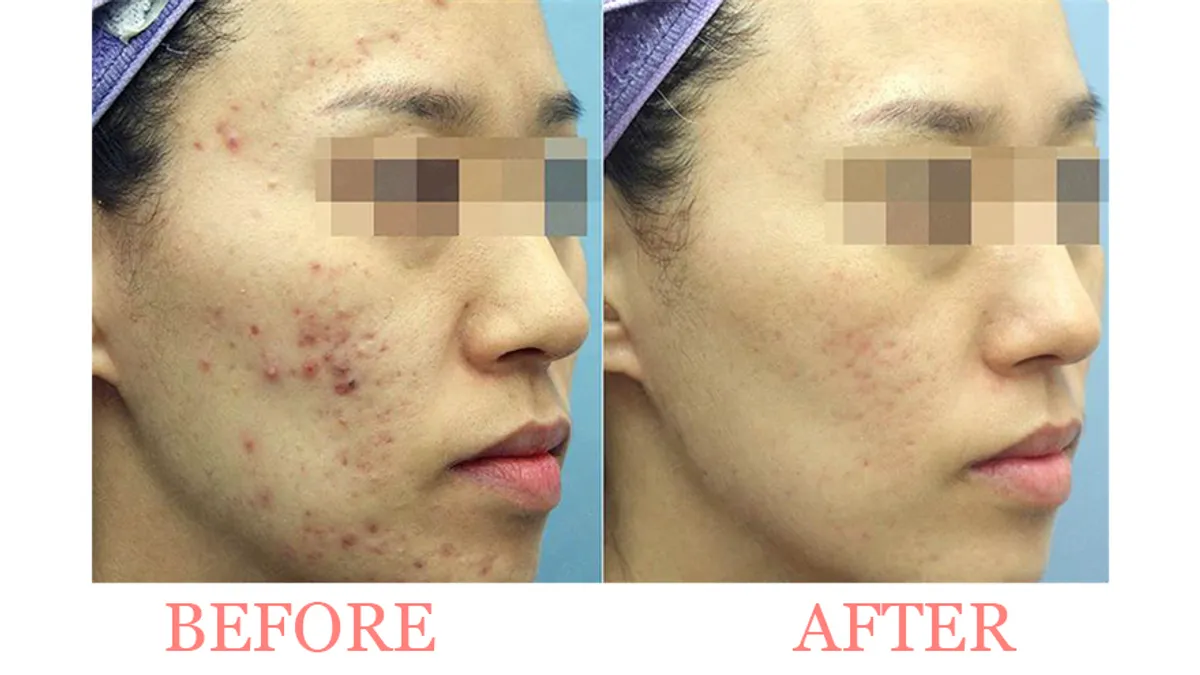 before and after of uneven skin maintenance