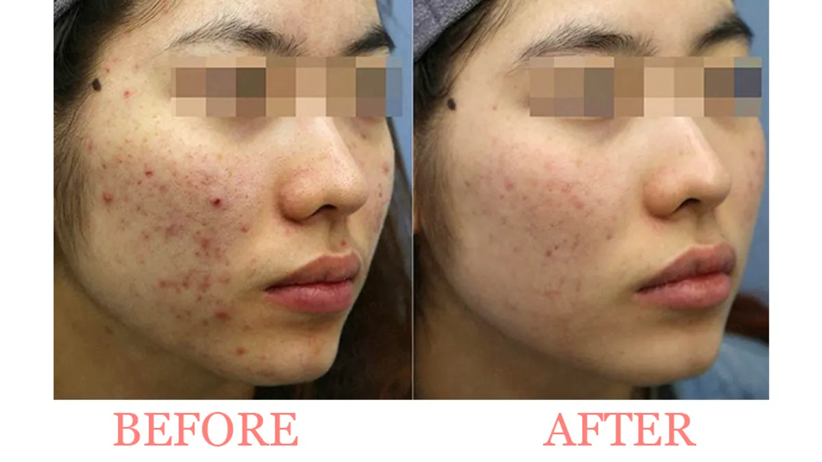 Acne Peel Care Before and after