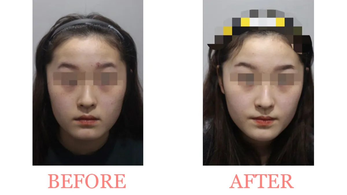 Skin Firmness Improvement before and after