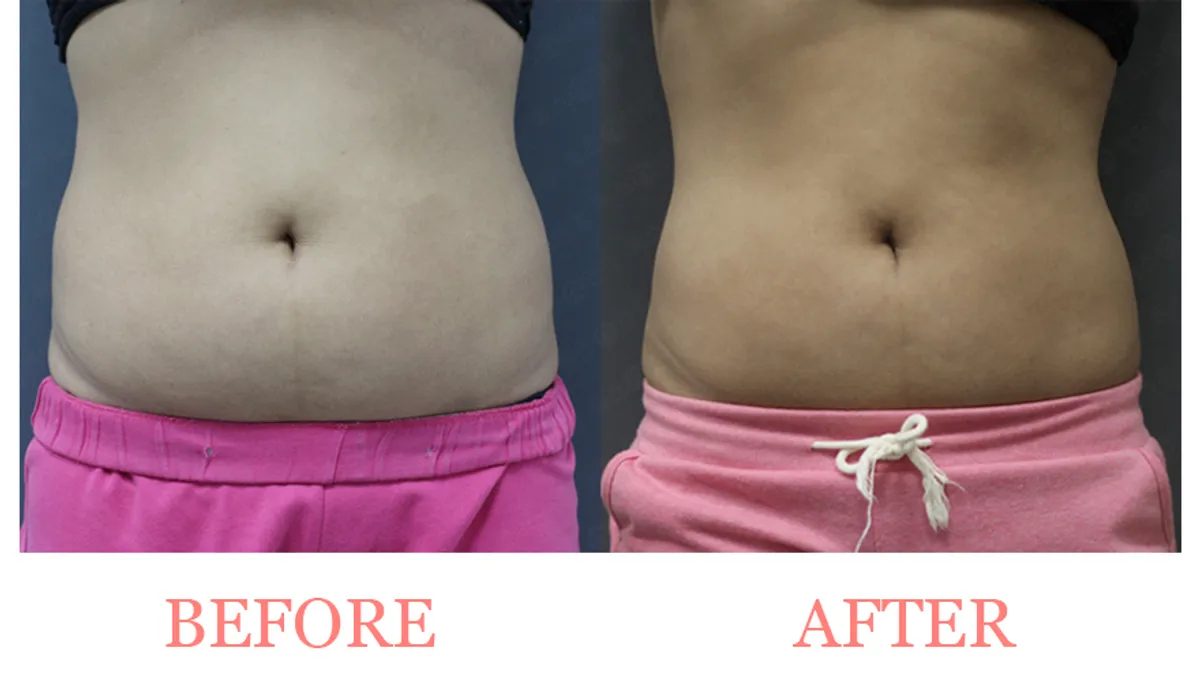 body slimming before and after