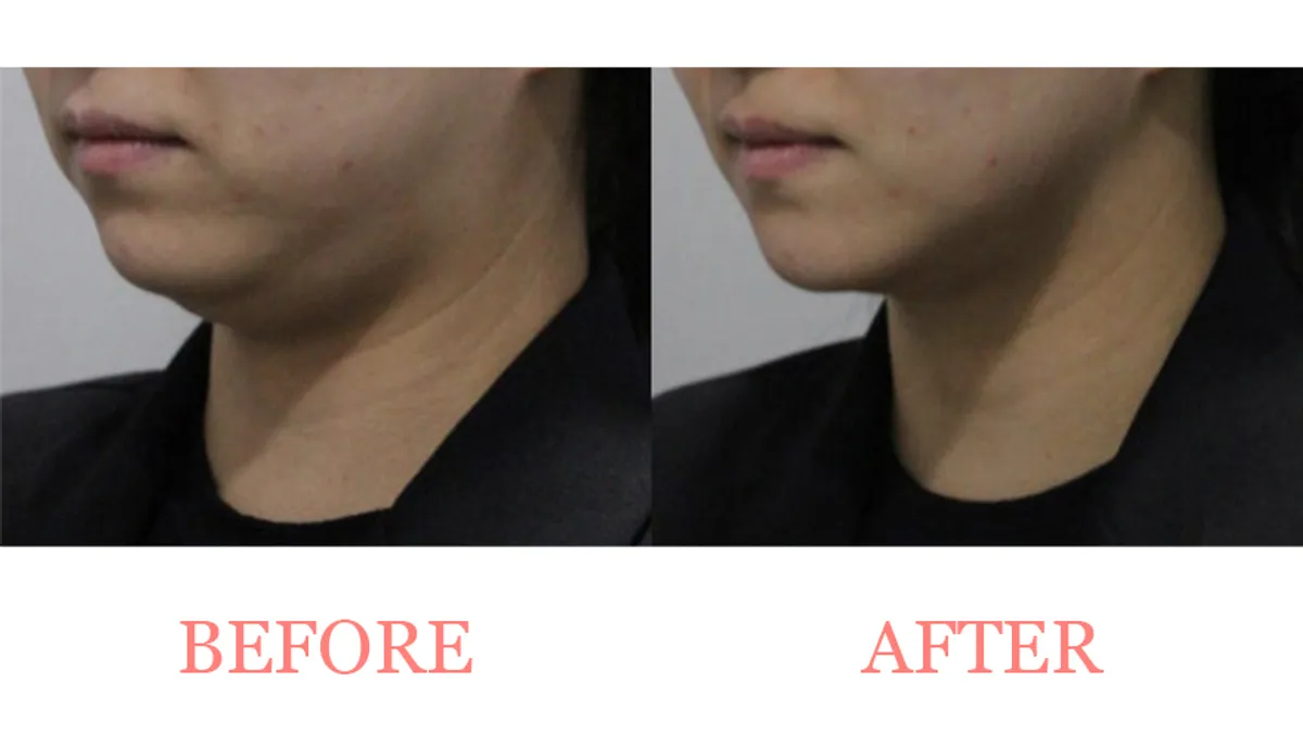 Jawline Definition Enhancement before and after