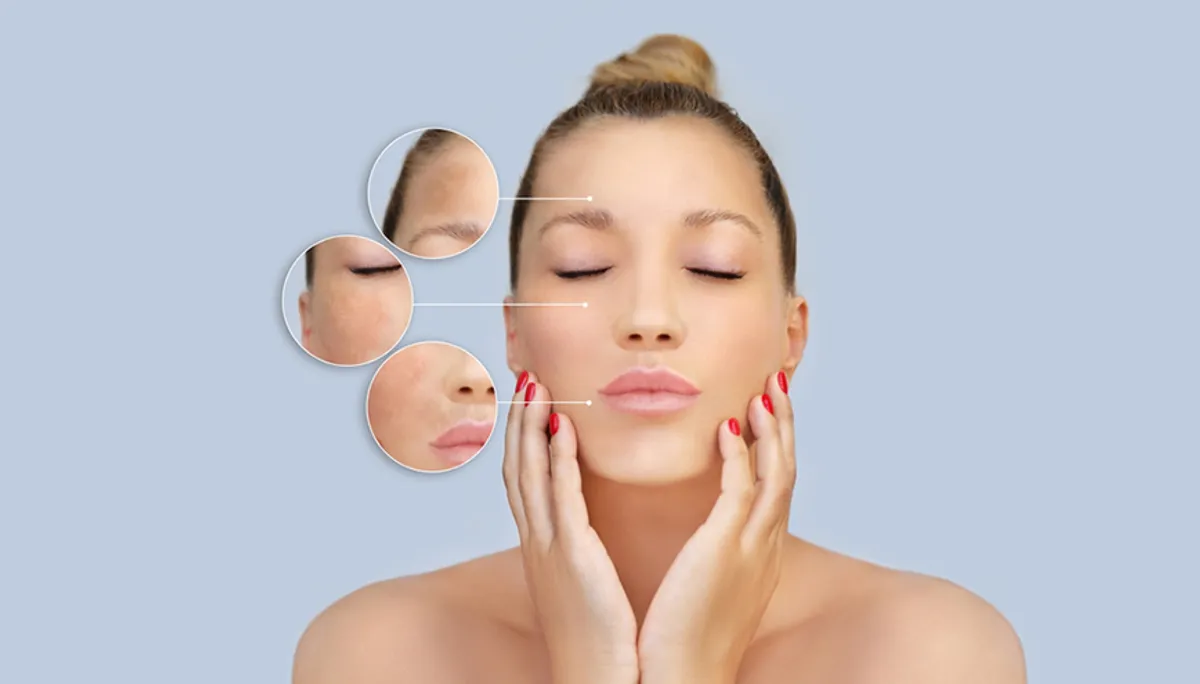 Hyperpigmentation