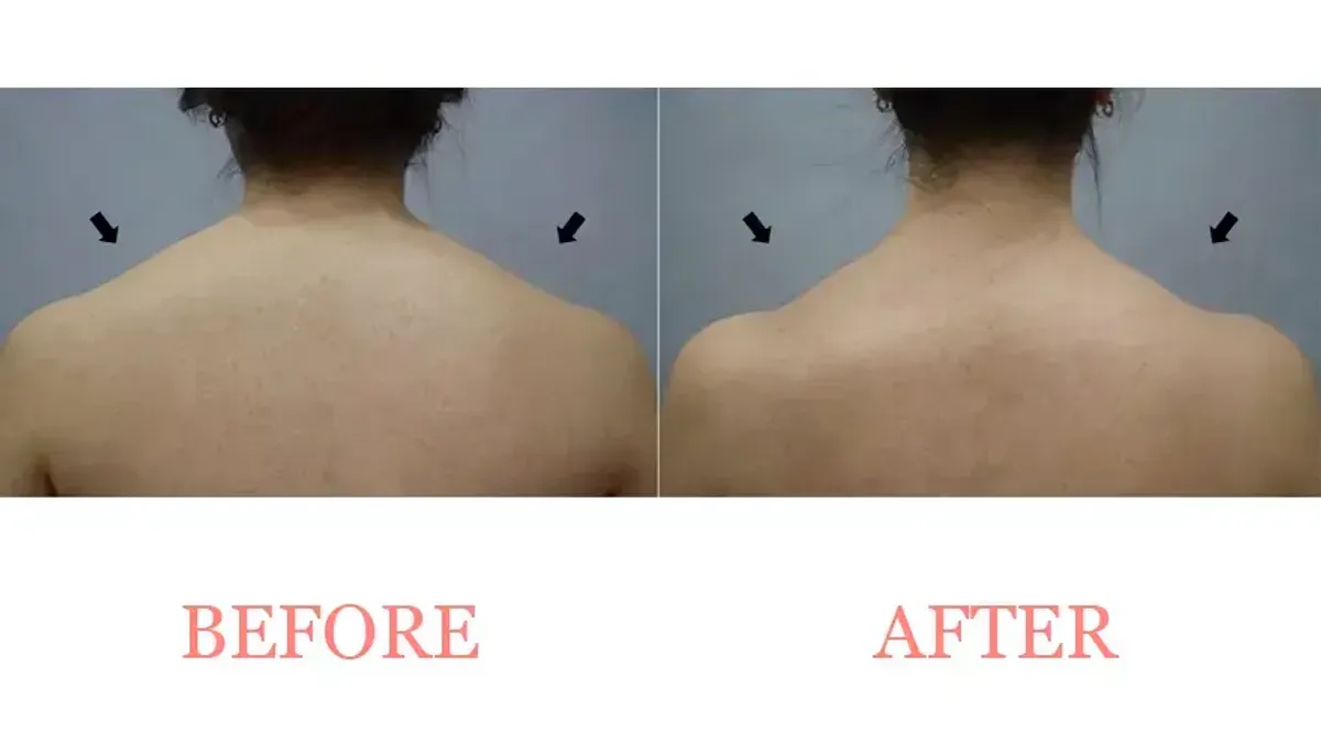 body slimming before and after