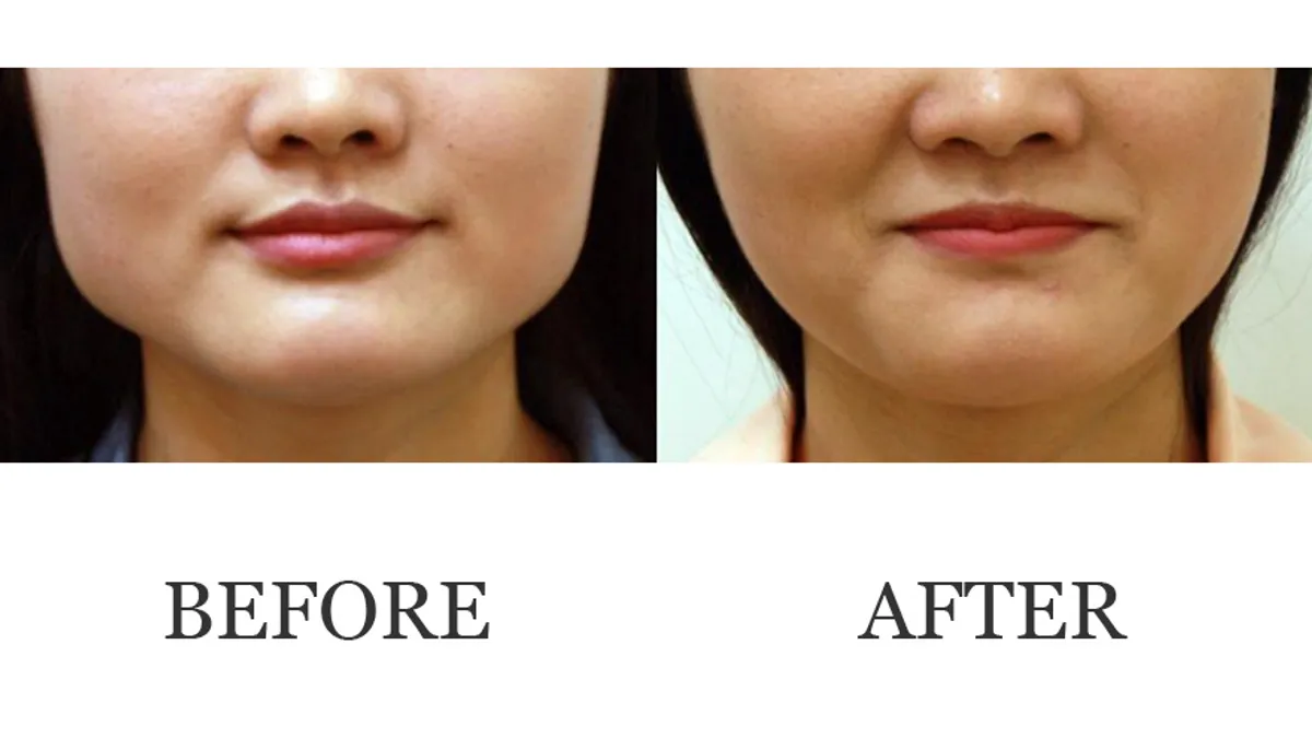 Non-Surgical Body Refinement  before and after