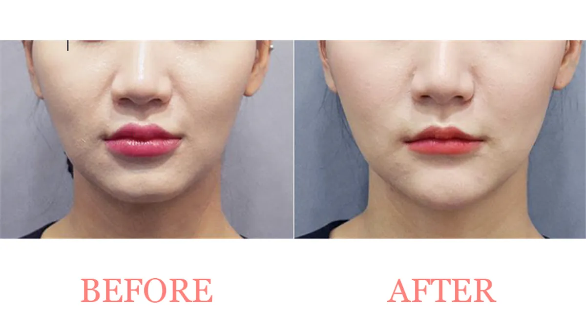 Subtle Facial Balance before and after