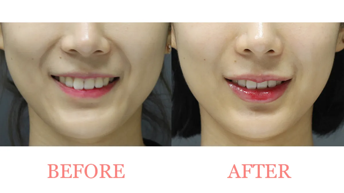 Natural Contourbefore and after