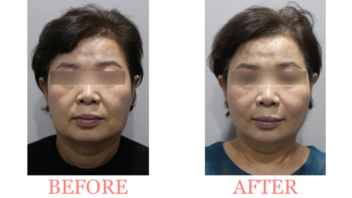 Facial Lifting Improvement before and after