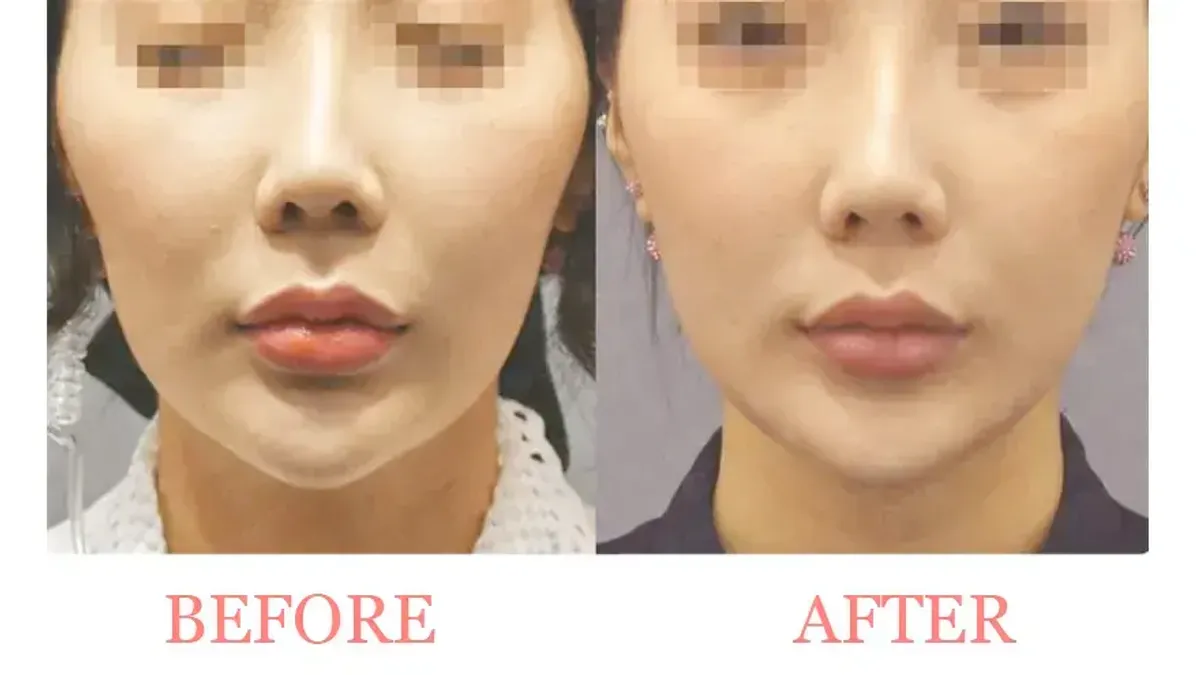 Jawline and Lower Face Tightening before and after