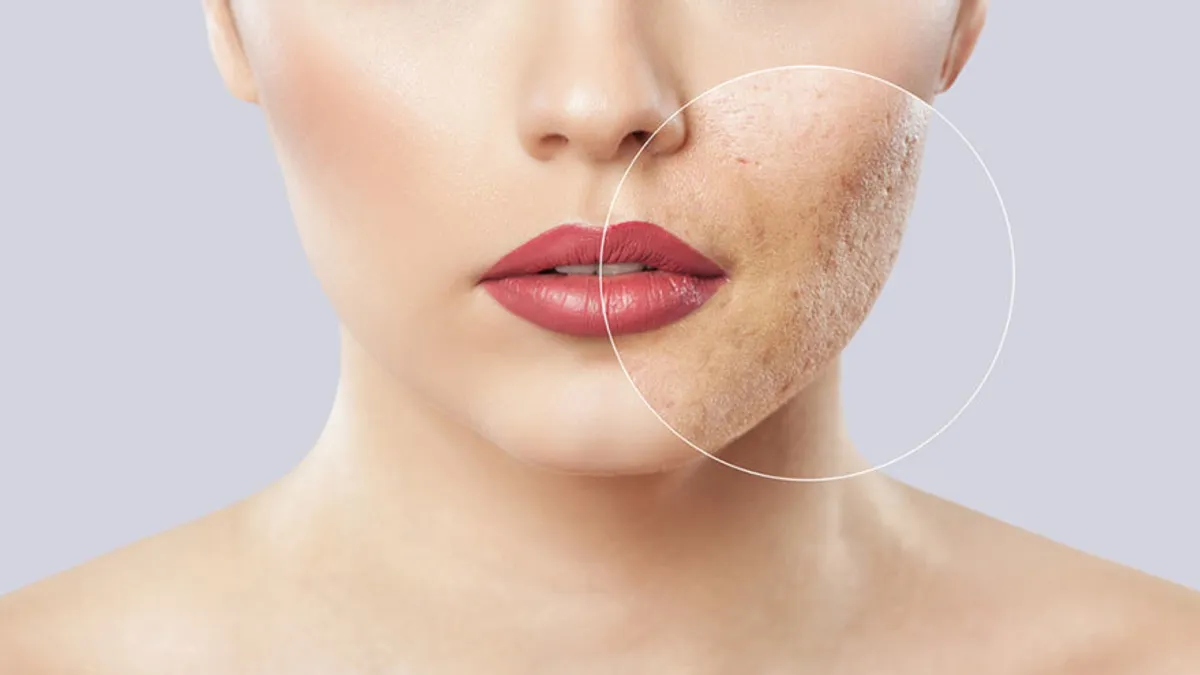 Aggressive Laser Resurfacing