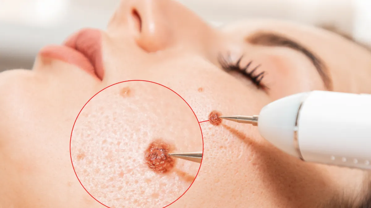 Moles, Milia & Warts Treatment Process