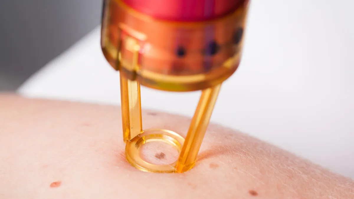 Mole removal