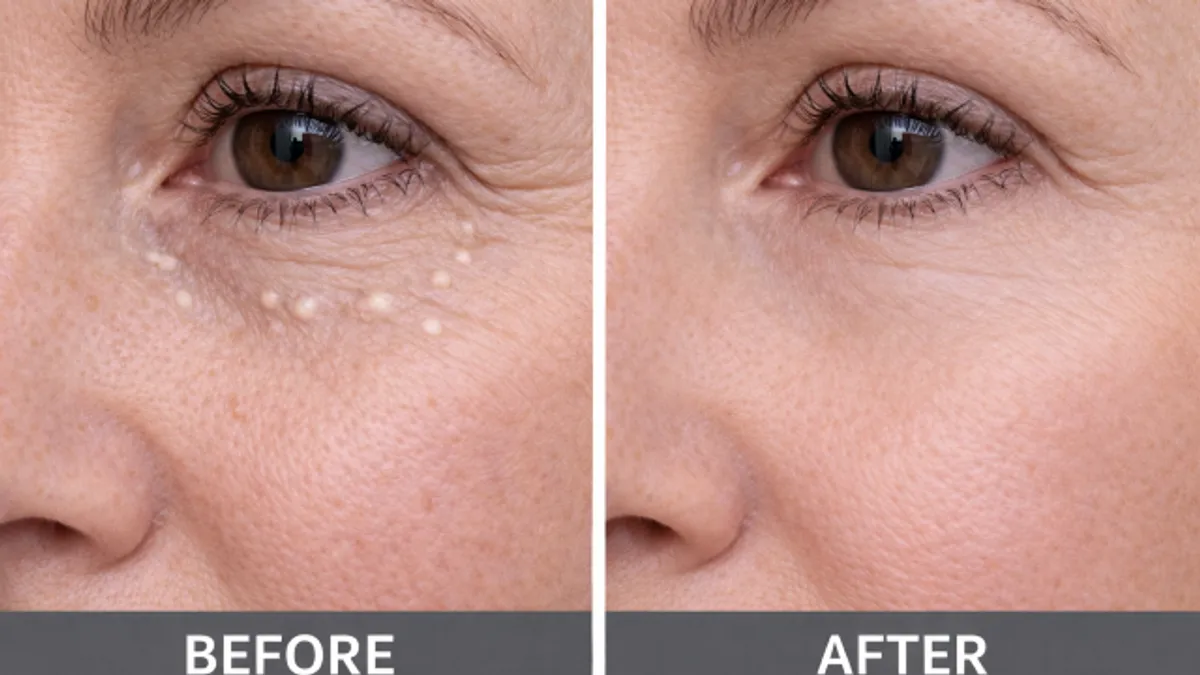 Milia Management before and after