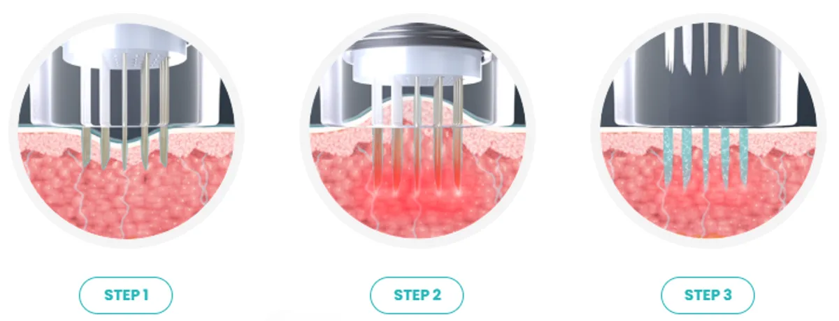 Potenza Treatment Features