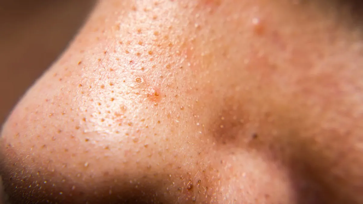 whiteheads, blackheads