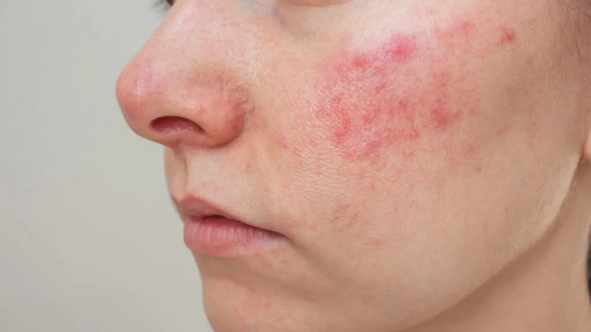 Chronic Redness or Flushing