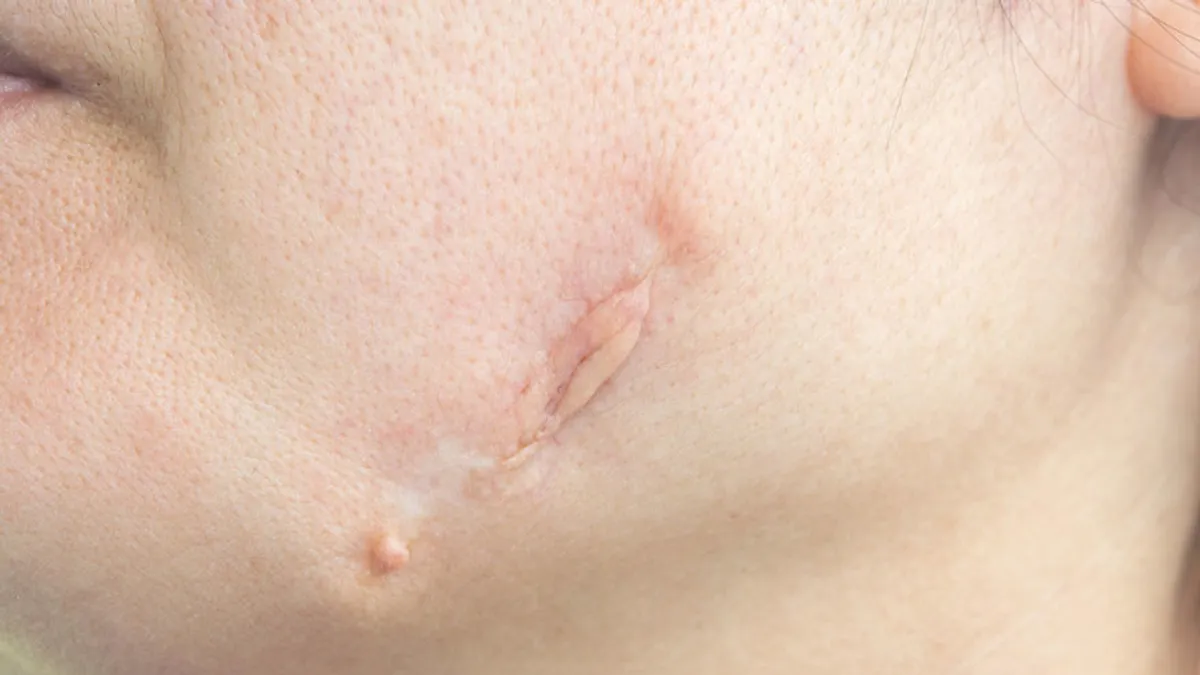 Acne Scars Won’t Go Away
