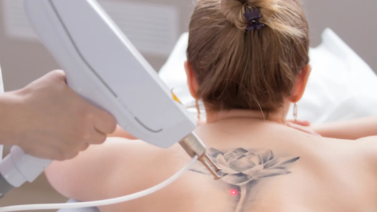 Tattoo removal