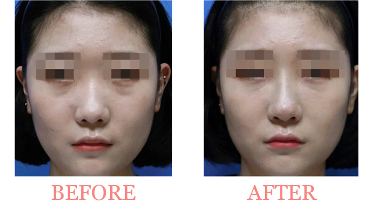 Under-Eye Filler Discomfort Resolution before and after