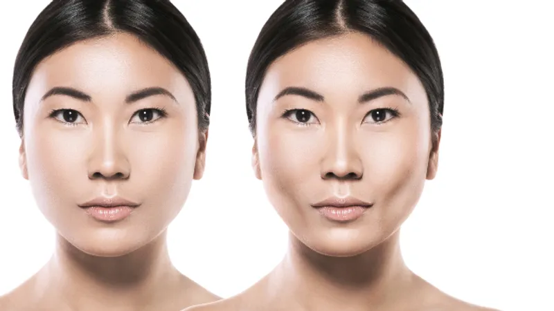 Before-and-after comparison showing changes in facial filler appearance following a filler dissolving treatment.